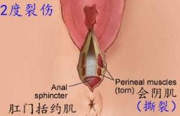 分娩时 会阴撕裂伤分级示意图