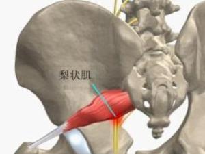 梨状肌综合征