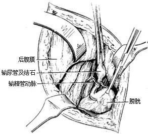 输尿管切开取石术图册