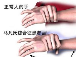 马方综合征